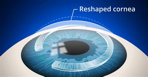 Gain Clear Vision with Corneal Ring Implant Surgery: Explore Your Options at the Optometrist